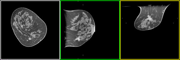 Indiana breast scanner tumor blood vessels