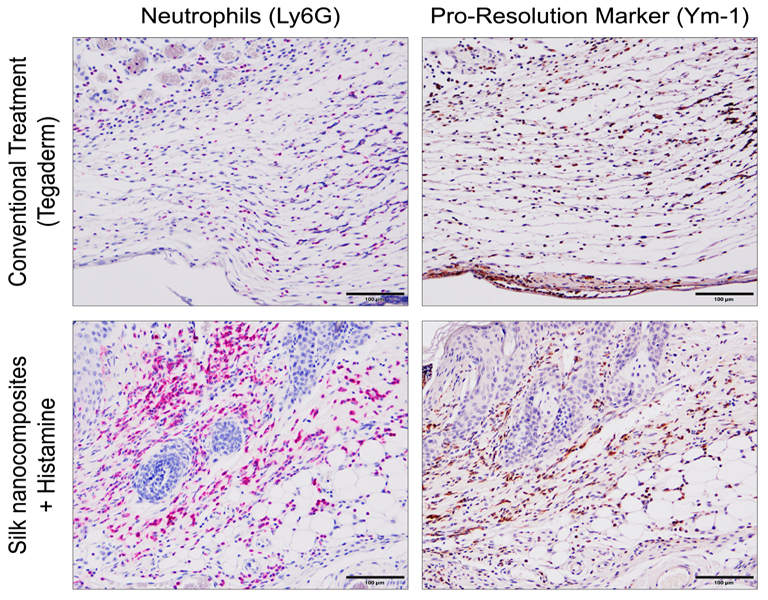 Four histological images of mouse tissue stained for neutrophils (Ly6G) and a pro-resolution marker (Ym-1). Tissue samples come from mice either treated with a silk nanocomposite and histamine or a conventional treatment. Both stains appear more prevalent in tissues treater with the former. 