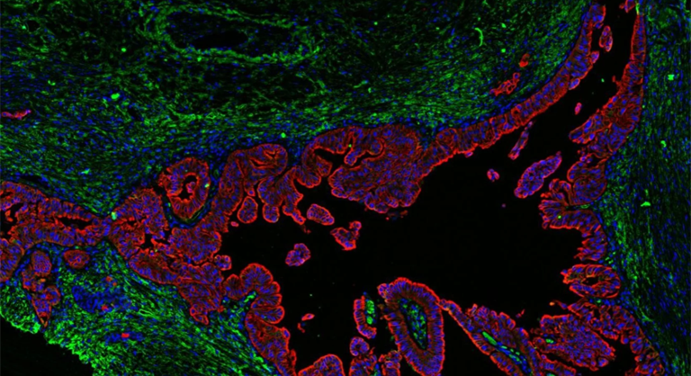 A fluorescence microscopy image showing pancreatic ductal adenocarcinoma (PDAC) tissue stained for cell nuclei, pancreatic cancer cells, and the extracellular matrix