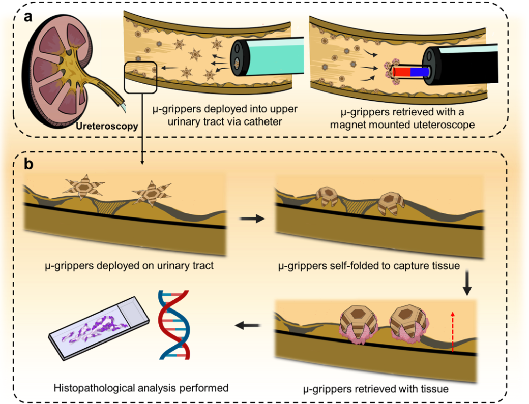 Cartoon representing how the microgrippers function in the upper urinary tract