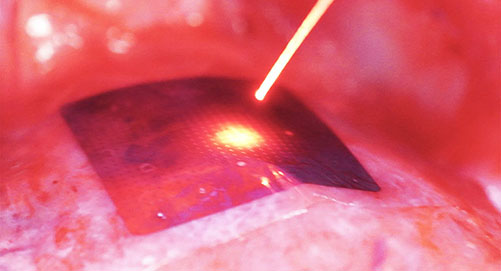 Photo of pacemaker device with light beams