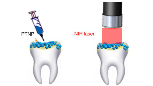 Cartoon showing gold nanoparticles applied to teeth followed by treatment with a laser