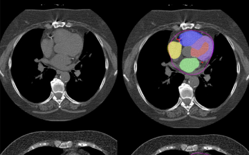 CT scan of chest with regions of the heart highlighted in different colors