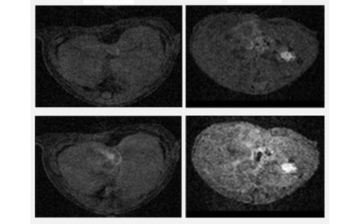 Fibrotic regions of liver as seen via MRI