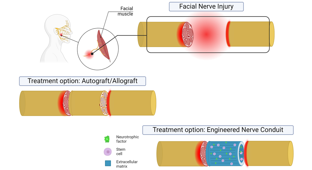 A graphic illustrating a facial nerve injury, treatment with an autograft, and treatment with an engineered nerve conduit