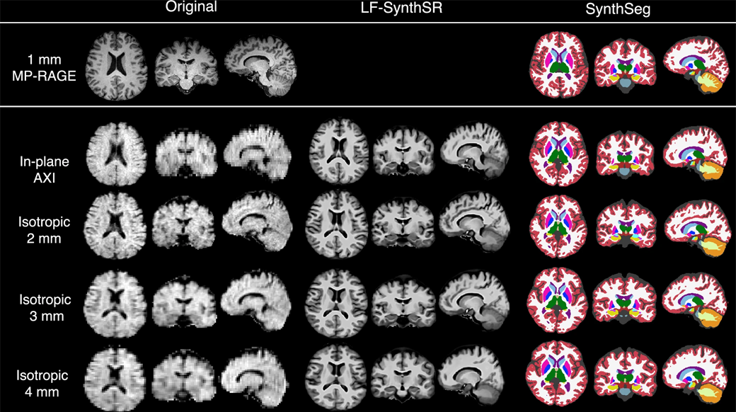 A three-column chart showing MRI images taken by either standard or low-field machines in the leftmost column, synthetic images in the middle, and segmented or assessed images in the rightmost column. 