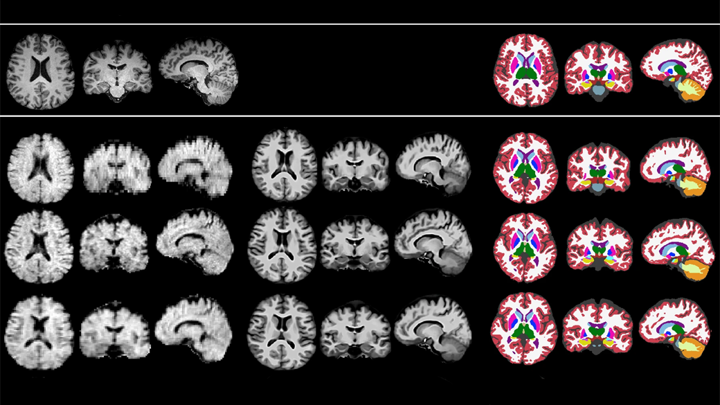 A three-column chart showing MRI images taken by either standard or low-field machines in the leftmost column, synthetic images in the middle, and segmented or assessed images in the rightmost column. 