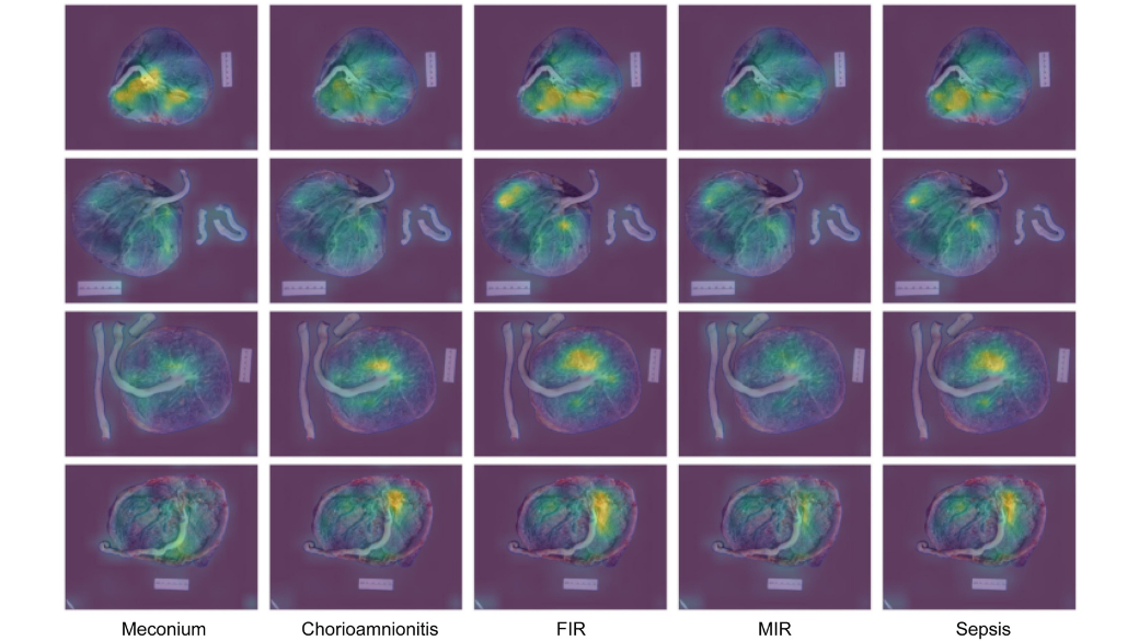 Photographs of four placentas that were analyzed by AI to predict outcomes, including infection and sepsis. Lighter areas of the photographs indicate larger prognostic "weight" as determined by the model.