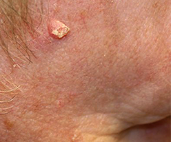 squamous cell carcinoma