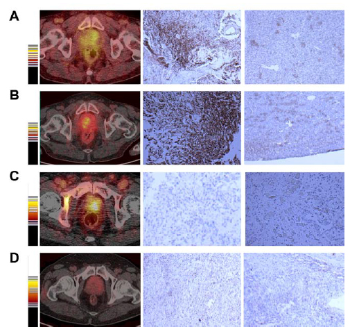 3 rows of images show PET scans and immunohistologic staining of prostates that are both positive and negative for cancer.