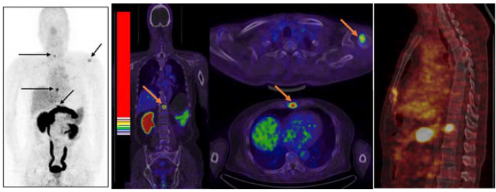 PET and CT scan images show prostate tumors glowing bright yellow, green, and black.