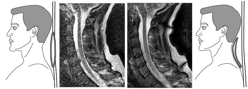 Two MRI images, one clearly better in quality, with drawings of coils and their placement.