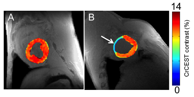 An image of two heart valves, the second showing tissue damage in blue