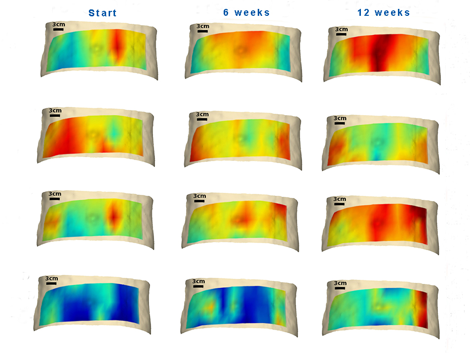Diffuse optical spectroscopic imaging of adipose tissue metabolic changes during weight loss Diffuse optical spectroscopic imaging of adipose tissue metabolic changes during weight loss