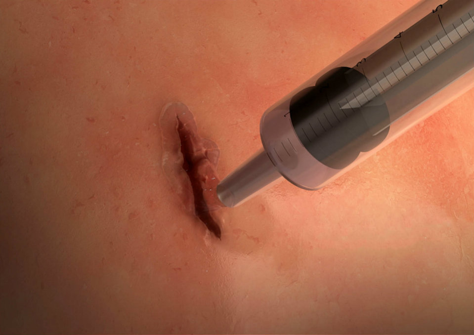 MeTro surgical glue applied to wound MeTro surgical glue applied to wound