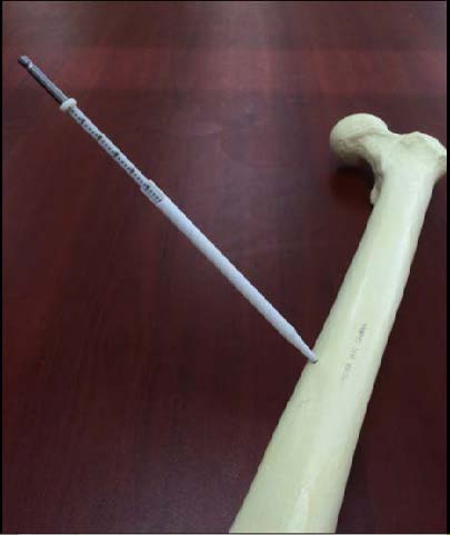 An image of the Sleeve inserted into a large bone