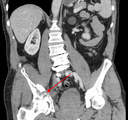 This is a picture of a hip fracture on a CT scan.