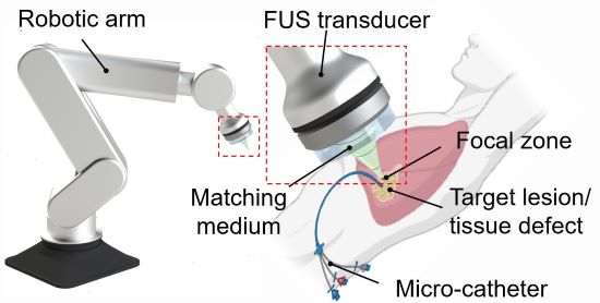 تصویری از یک بازوی روباتیک متصل به یک مبدل اولتراسوند متمرکز که روی سینه انسان قرار دارد.  یک میکروکاتتر جوهر را به ناحیه زیر مبدل تزریق می کند.