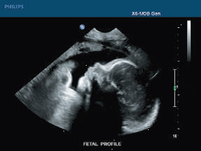 How It Works: Doppler Ultrasound Imaging
