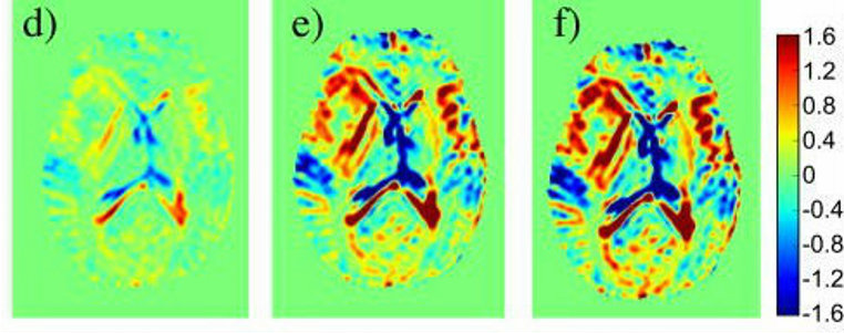 MRI images of brain with D-glucose enhancement