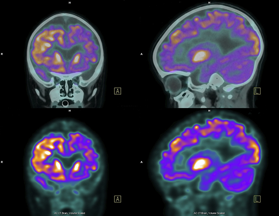 PET scans