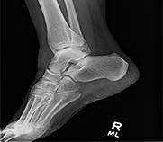 人类脚踝的X光照片