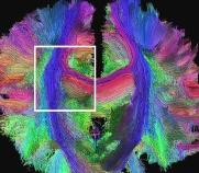 使用MRI/DTI进行人脑扫描