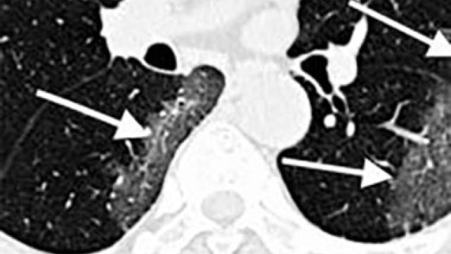 CT Lungs Covid 19