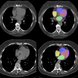 AI is applied to CT scans to automatically segment different heart chambers and identify arterial plaque