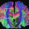 human brain scan using MRI/DTI