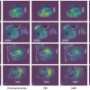 Photographs of four placentas that were analyzed by AI to predict outcomes, including infection and sepsis. Lighter areas of the photographs indicate larger prognostic "weight" as determined by the model.